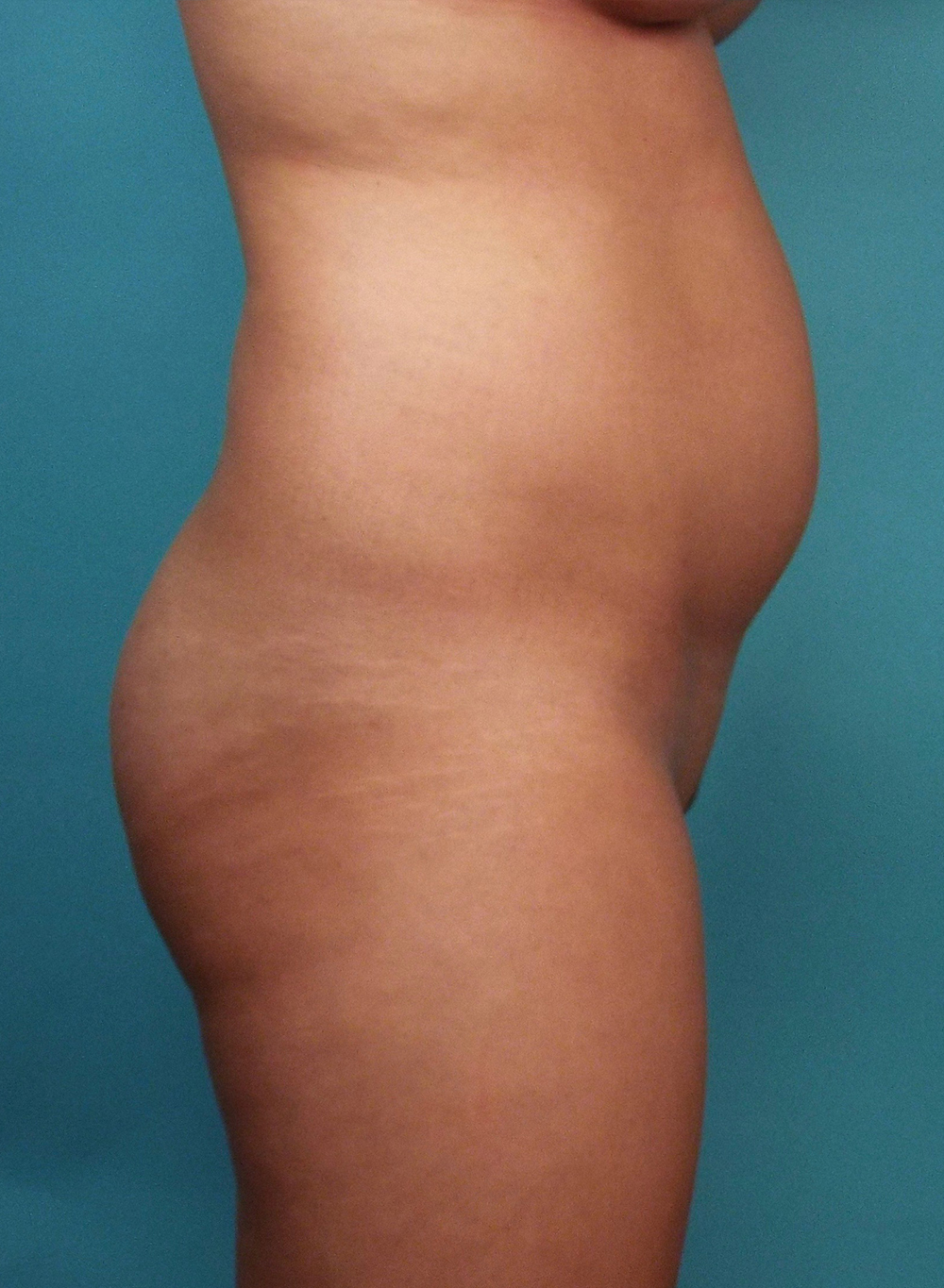 Liposuction Before and After | Dr Evan W Beale