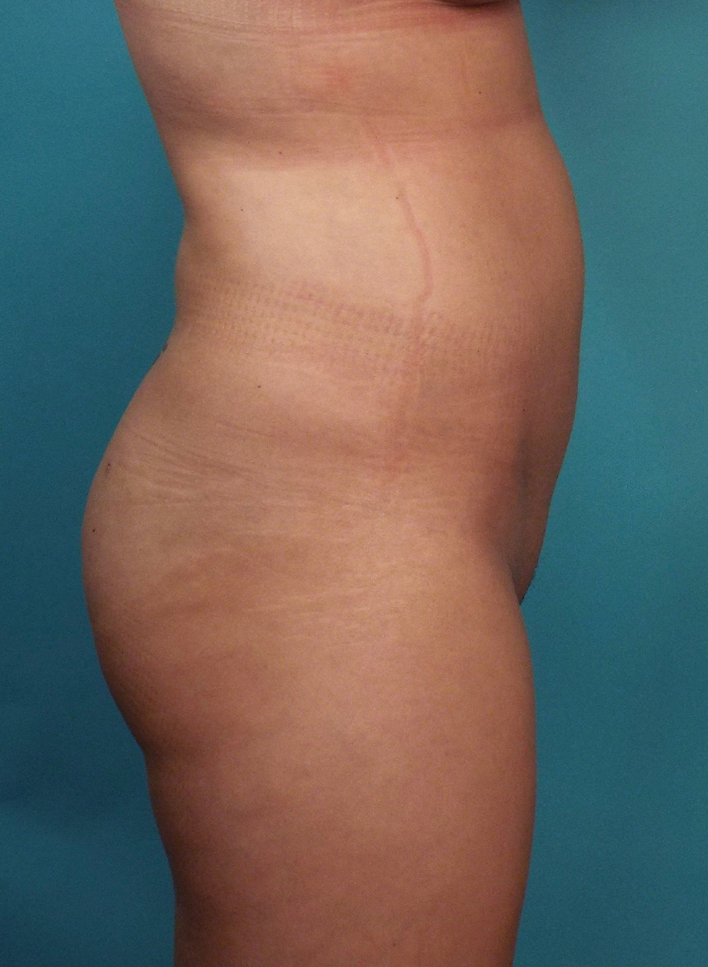 Liposuction Before and After | Dr Evan W Beale