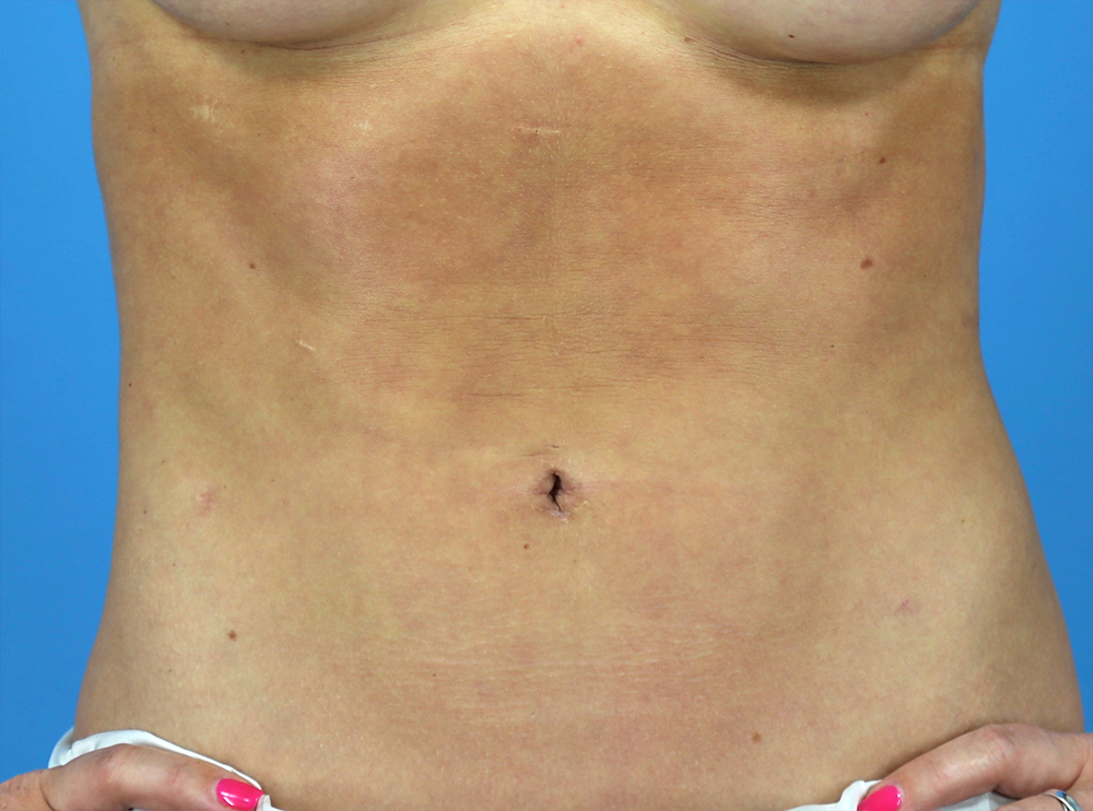 Liposuction Before and After | Dr Evan W Beale