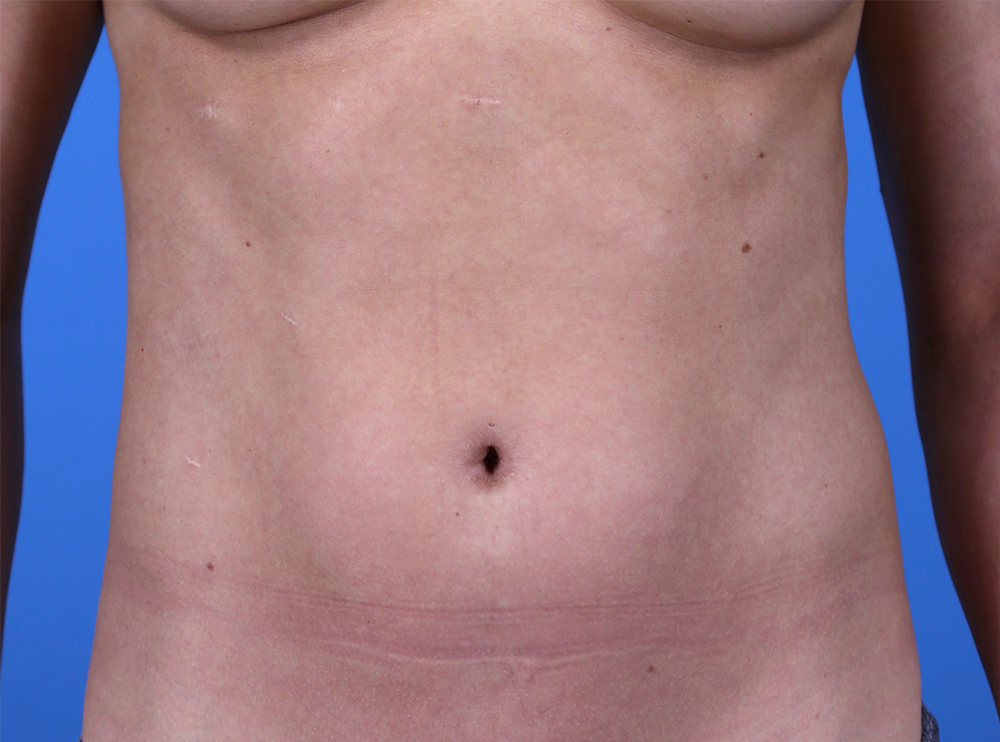 Liposuction Before and After | Dr Evan W Beale