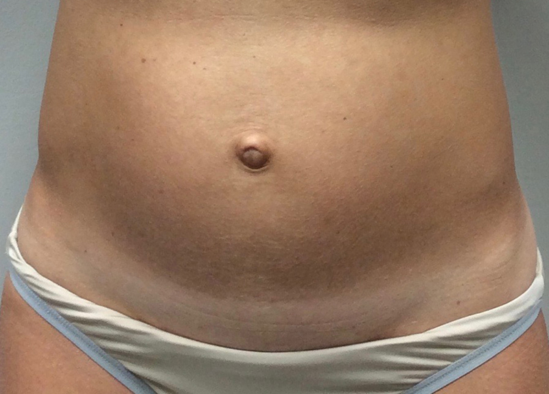 Mini Tummy Tuck Before and After | Dr Evan W Beale