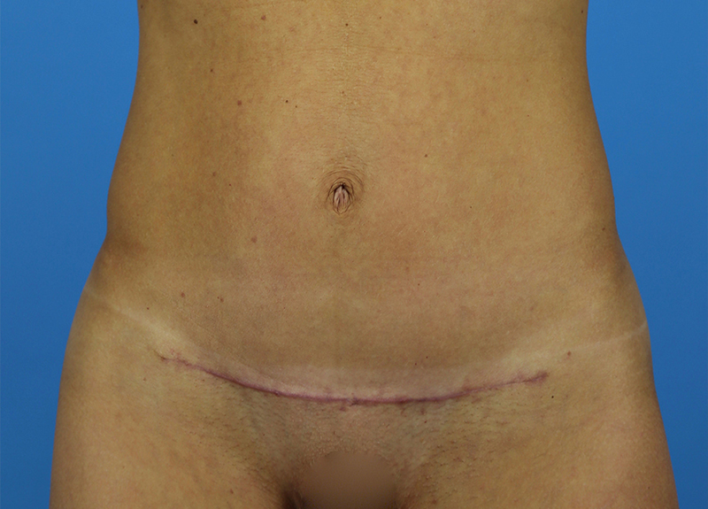 Mini Tummy Tuck Before and After | Dr Evan W Beale