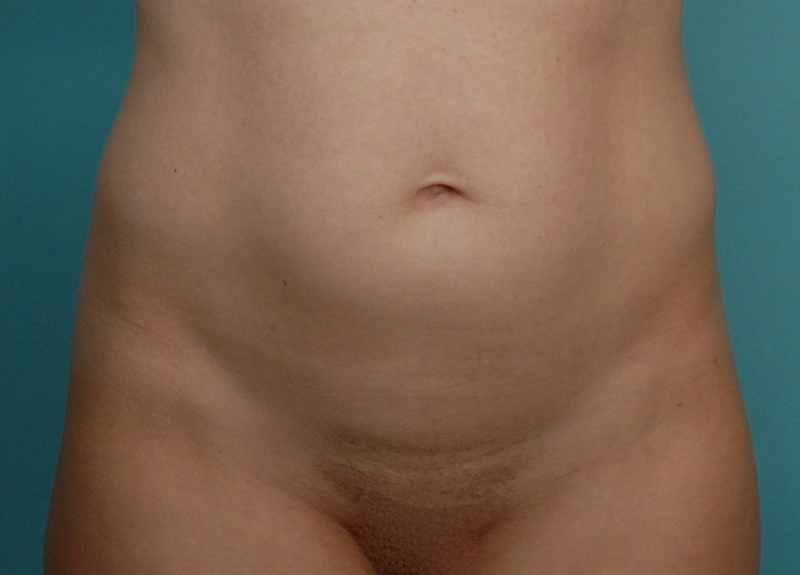 Mini Tummy Tuck Before and After | Dr Evan W Beale