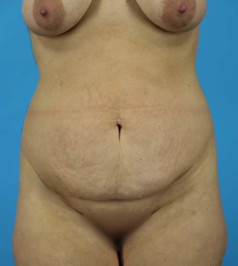 Mommy Makeover Before and After | Dr Evan W Beale