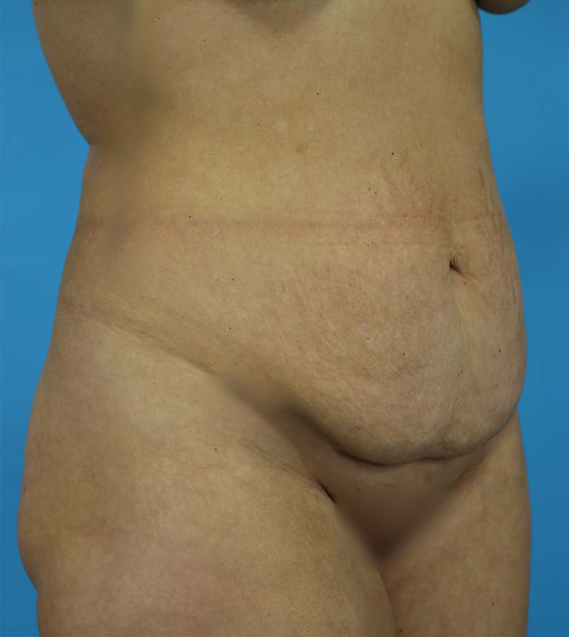 Mommy Makeover Before and After | Dr Evan W Beale