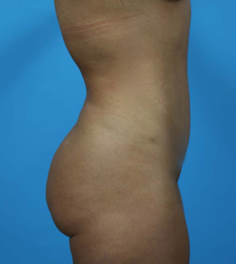 Mommy Makeover Before and After | Dr Evan W Beale