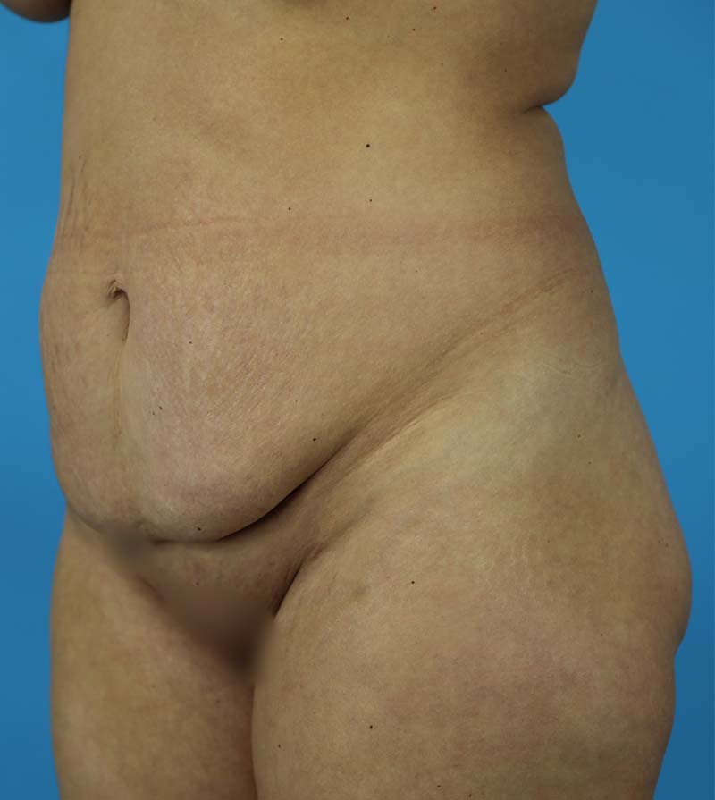 Mommy Makeover Before and After | Dr Evan W Beale