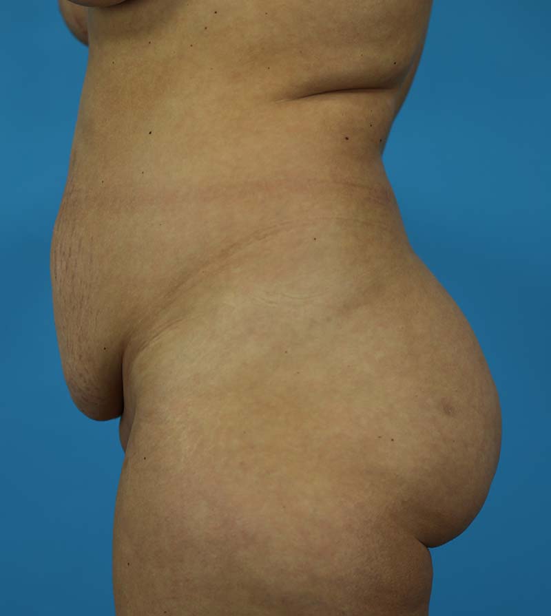 Mommy Makeover Before and After | Dr Evan W Beale