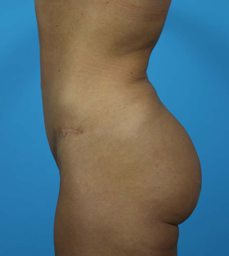 Mommy Makeover Before and After | Dr Evan W Beale