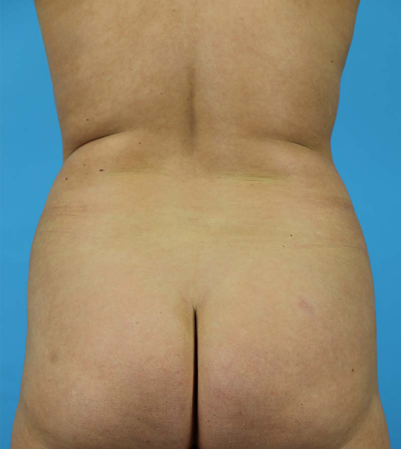 Mommy Makeover Before and After | Dr Evan W Beale