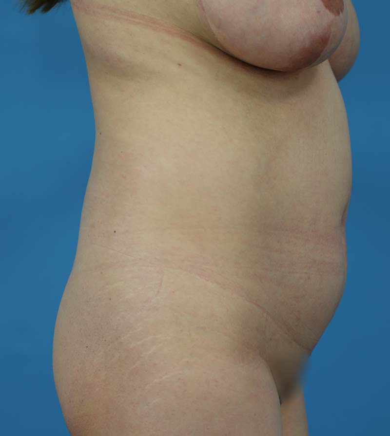 Mommy Makeover Before and After | Dr Evan W Beale