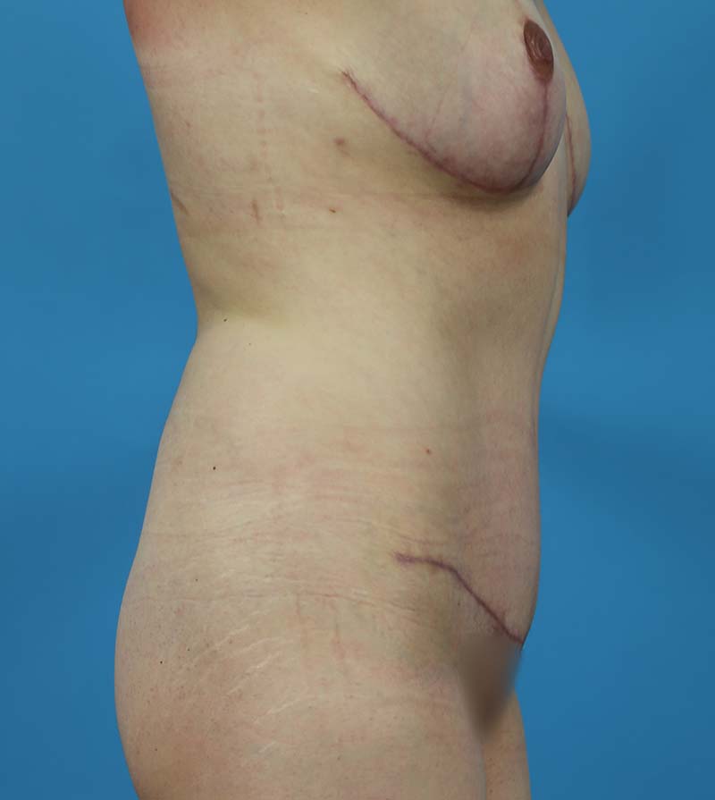 Mommy Makeover Before and After | Dr Evan W Beale