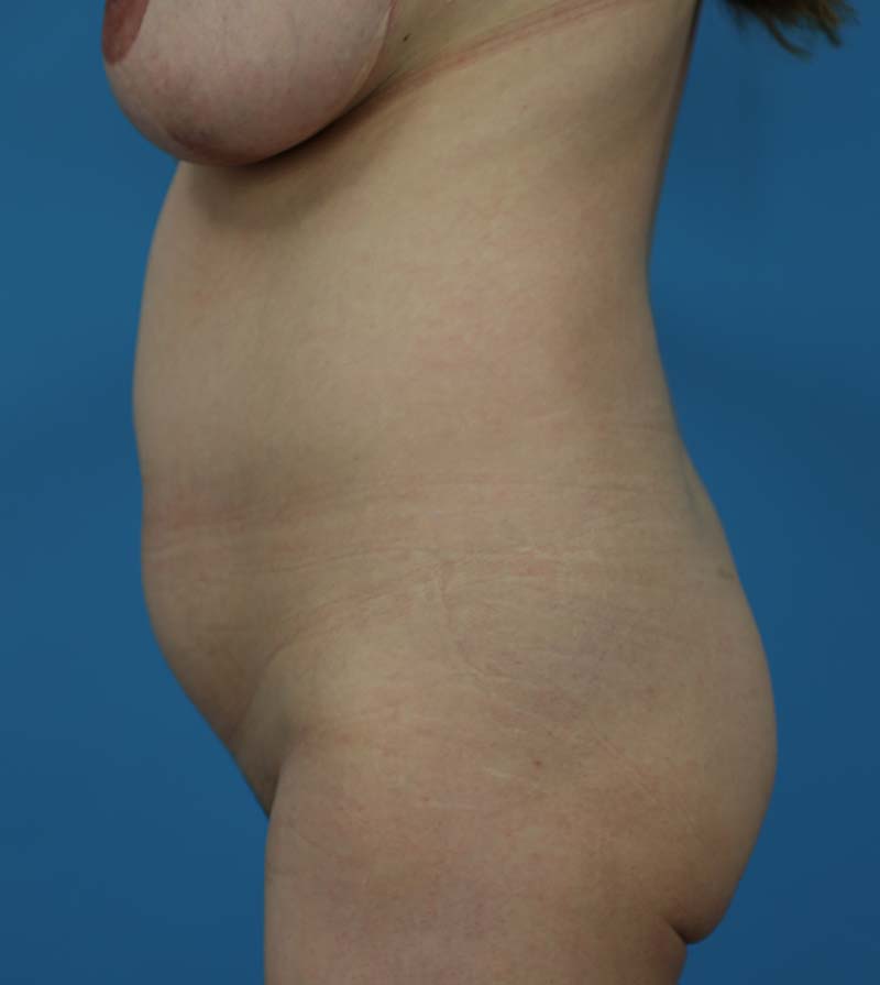 Mommy Makeover Before and After | Dr Evan W Beale