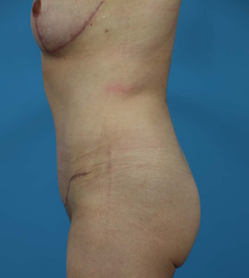 Mommy Makeover Before and After | Dr Evan W Beale