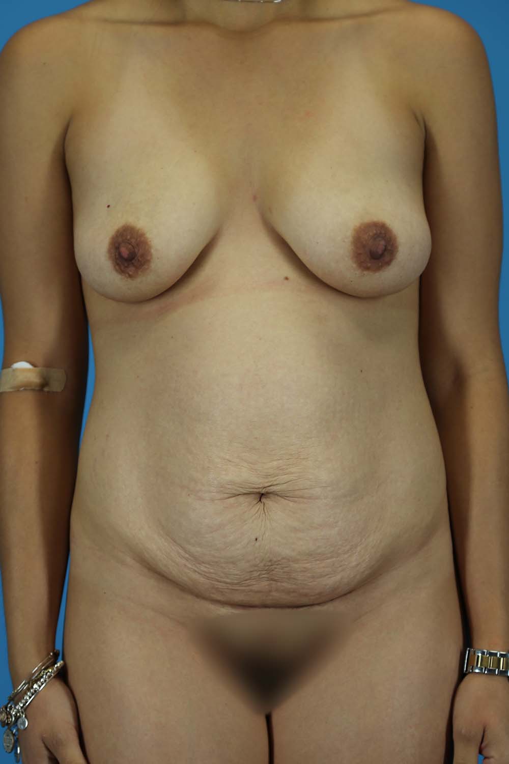 Mommy Makeover Before and After | Dr Evan W Beale