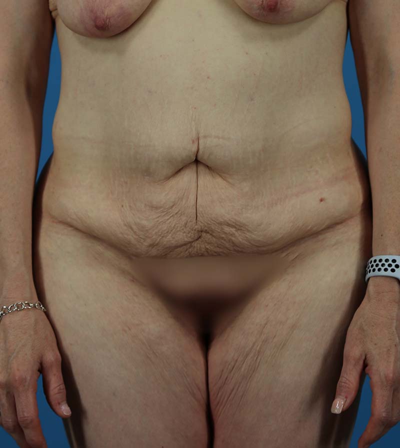 Mommy Makeover Before and After | Dr Evan W Beale