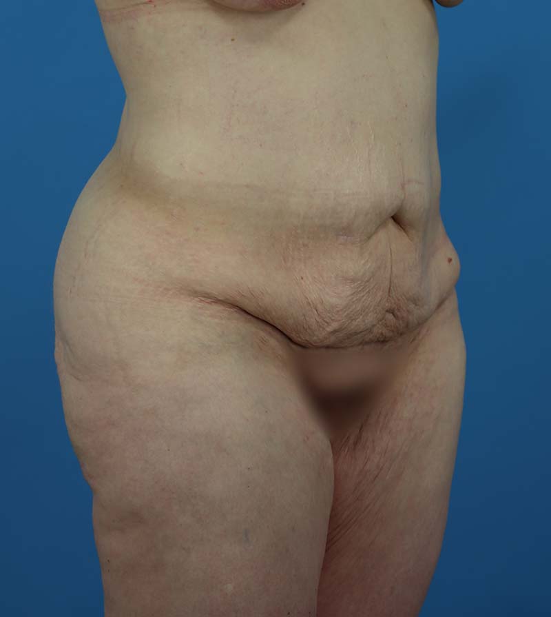 Mommy Makeover Before and After | Dr Evan W Beale