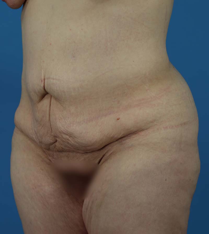Mommy Makeover Before and After | Dr Evan W Beale