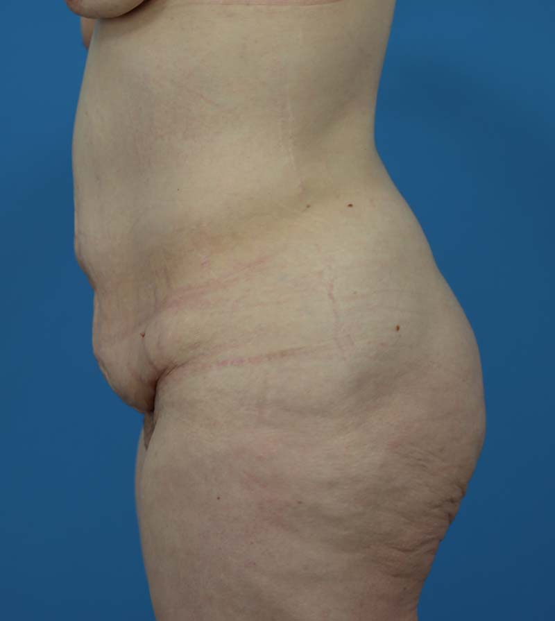 Mommy Makeover Before and After | Dr Evan W Beale