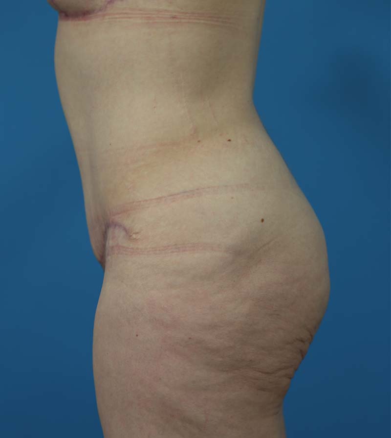 Mommy Makeover Before and After | Dr Evan W Beale