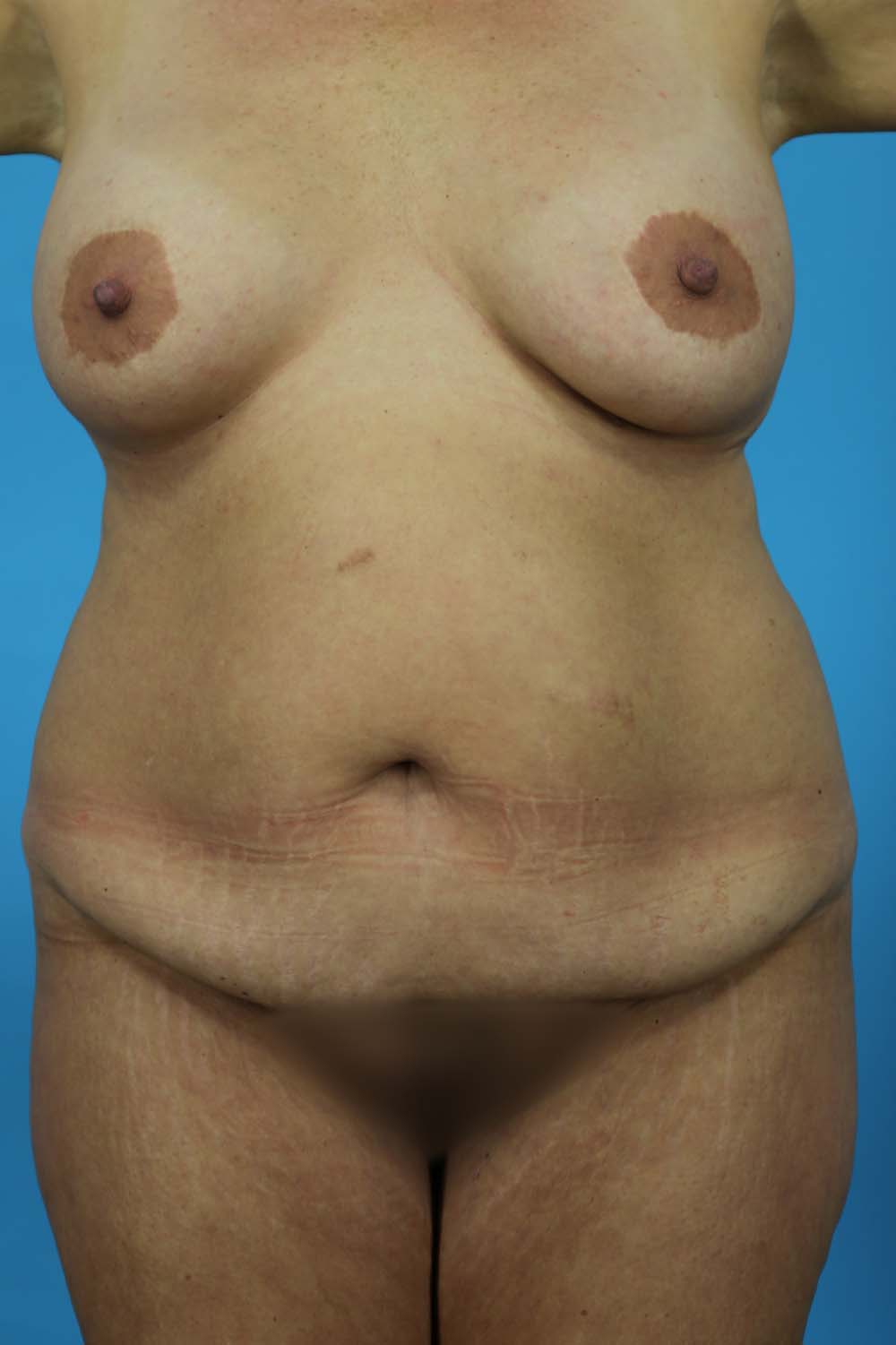 Mommy Makeover Before and After | Dr Evan W Beale