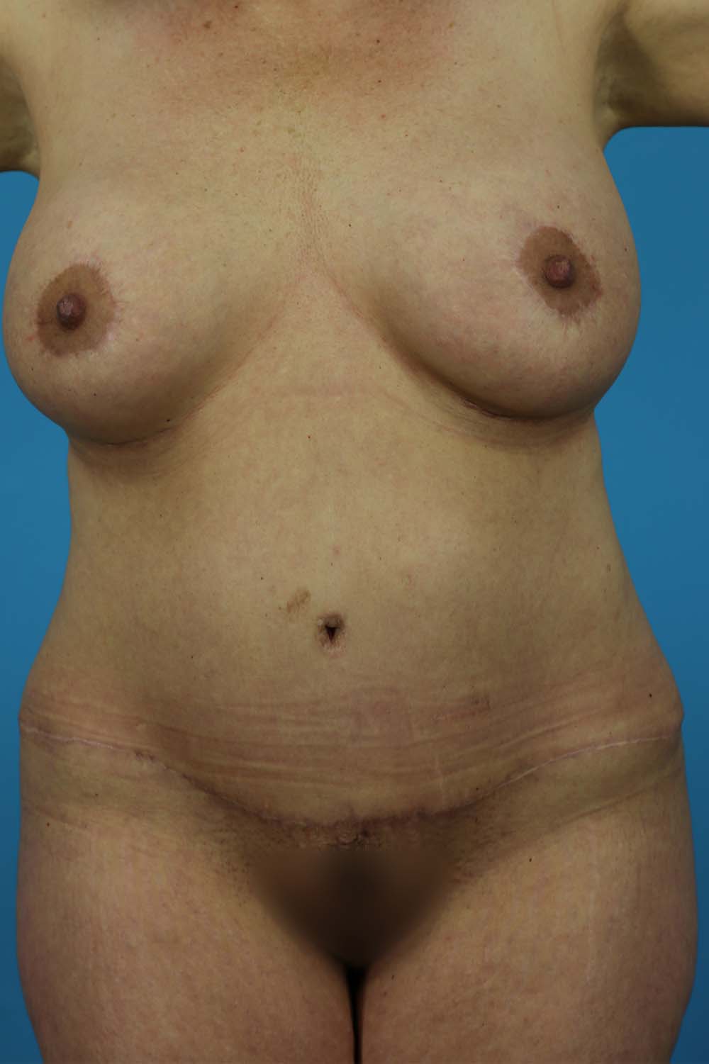 Mommy Makeover Before and After | Dr Evan W Beale