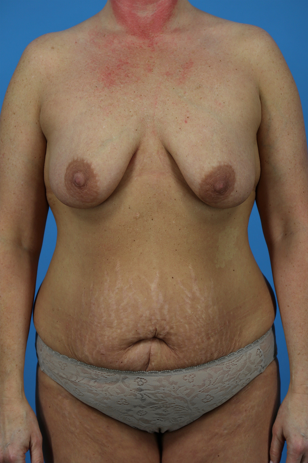 Mommy Makeover Before and After | Dr Evan W Beale