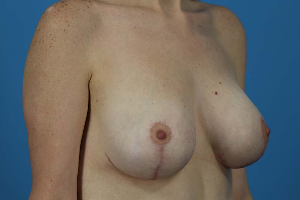 Breast Augmentation With Mastopexy Before and After | Dr Evan W Beale