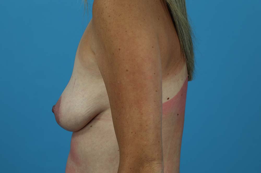 Breast Augmentation With Mastopexy Before and After | Dr Evan W Beale