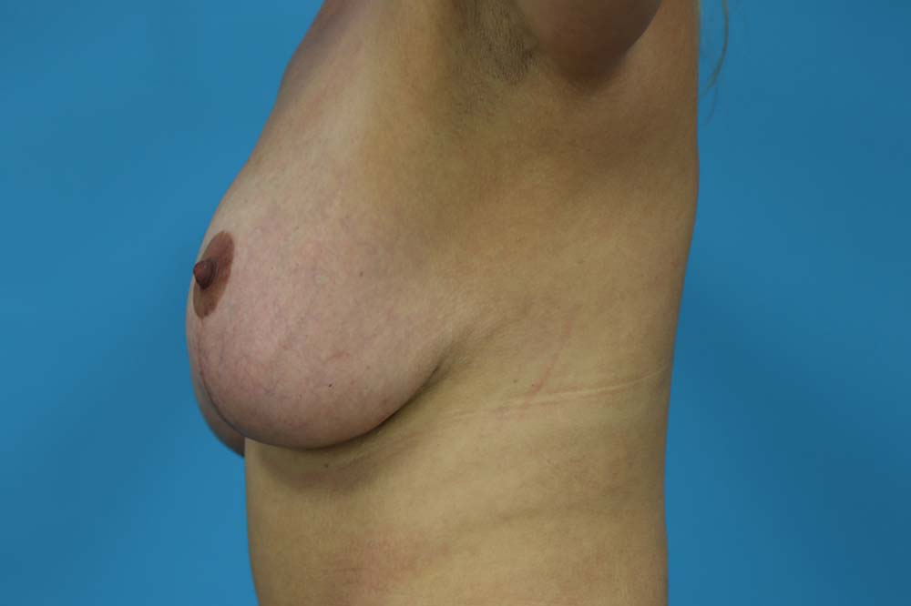 Breast Augmentation With Mastopexy Before and After | Dr Evan W Beale