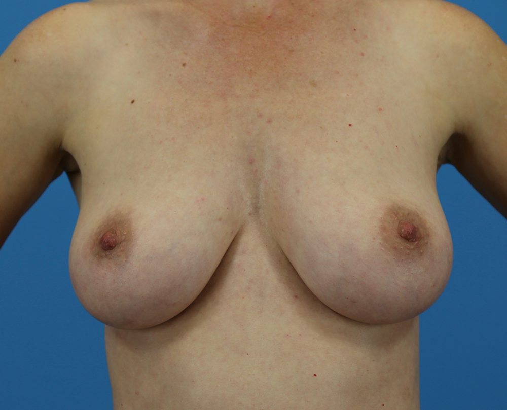 Breast Augmentation With Mastopexy Before and After | Dr Evan W Beale