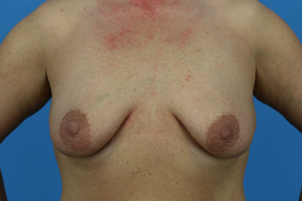 Breast Augmentation With Mastopexy Before and After | Dr Evan W Beale