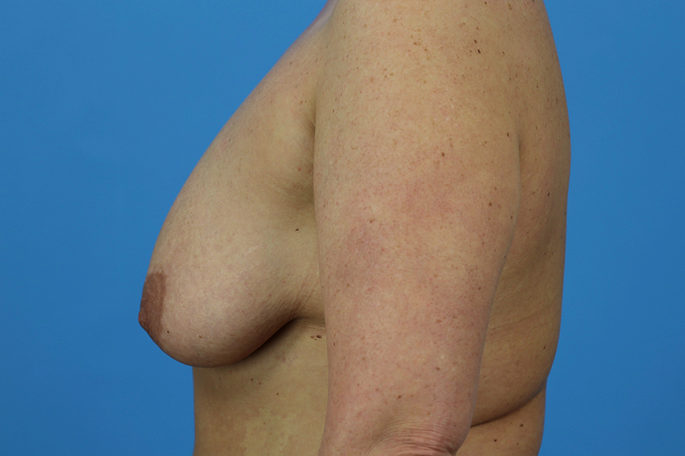 Breast Augmentation With Mastopexy Before and After | Dr Evan W Beale