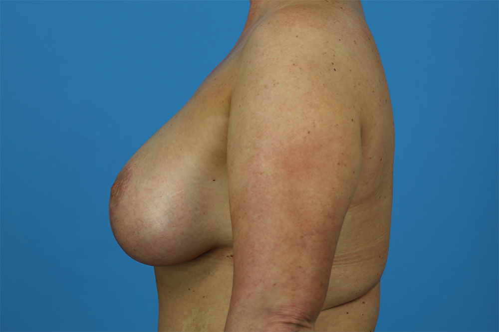 Breast Augmentation With Mastopexy Before and After | Dr Evan W Beale