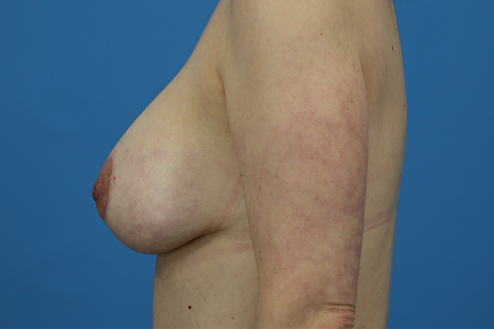 Breast Augmentation With Mastopexy Before and After | Dr Evan W Beale