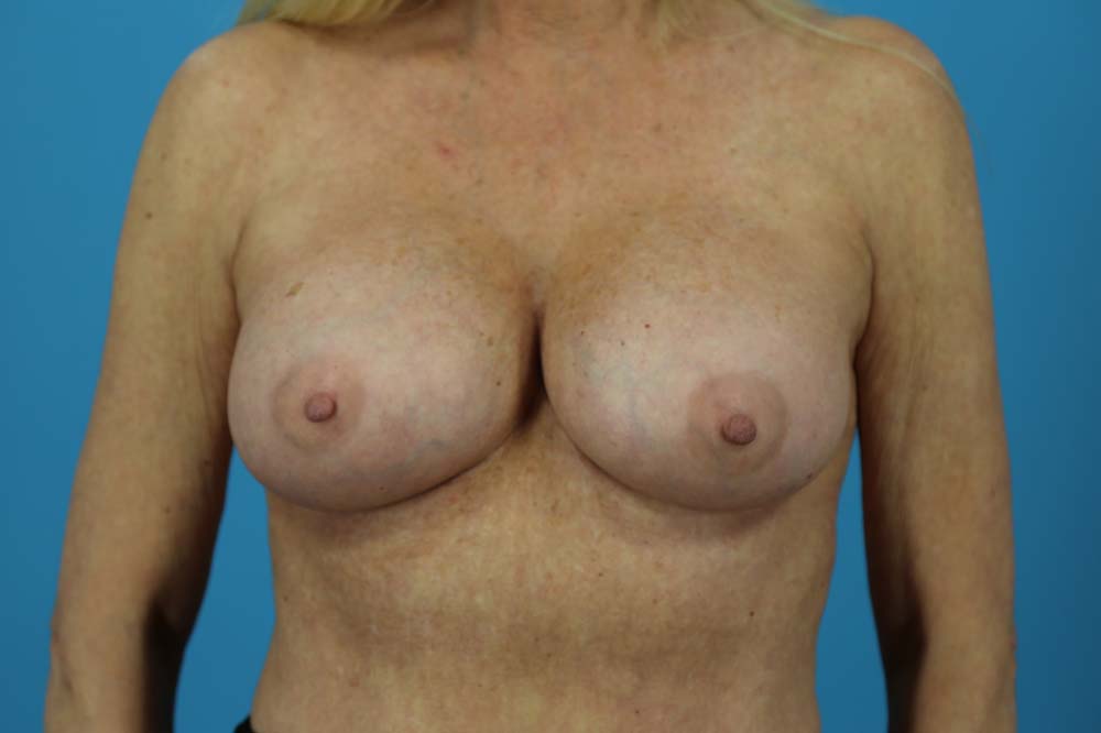 Breast Augmentation Before and After | Dr Evan W Beale