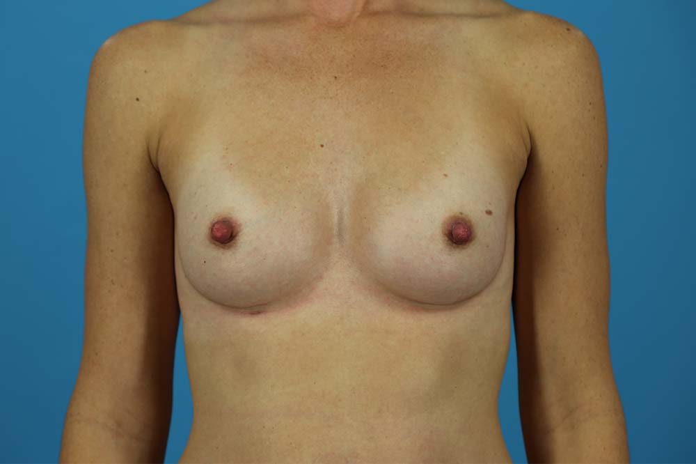 Breast Augmentation Before and After | Dr Evan W Beale