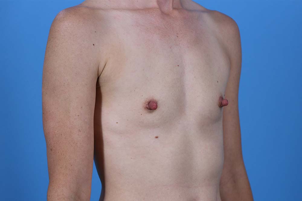 Breast Augmentation Before and After | Dr Evan W Beale