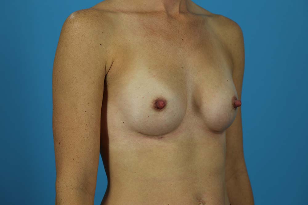 Breast Augmentation Before and After | Dr Evan W Beale