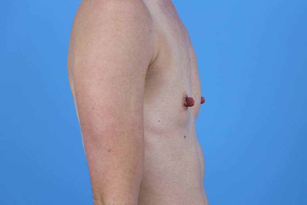 Breast Augmentation Before and After | Dr Evan W Beale