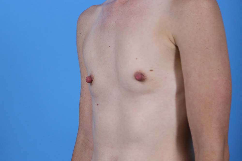 Breast Augmentation Before and After | Dr Evan W Beale