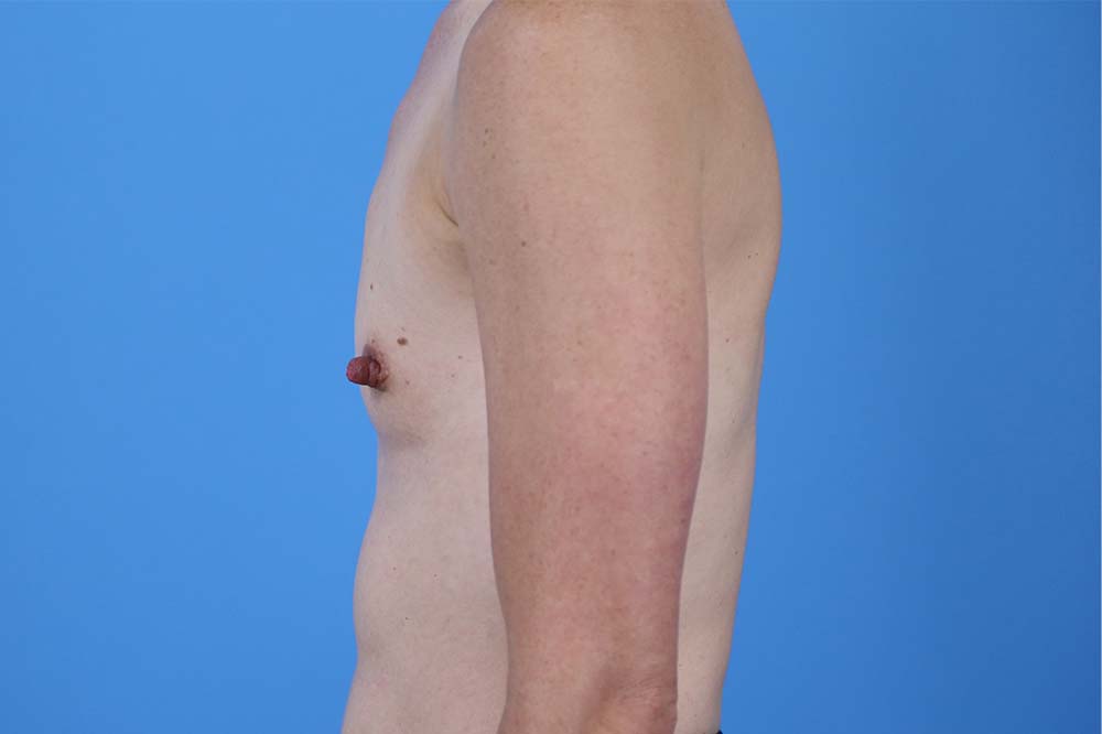 Breast Augmentation Before and After | Dr Evan W Beale