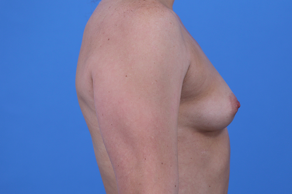 Breast Augmentation Before and After | Dr Evan W Beale