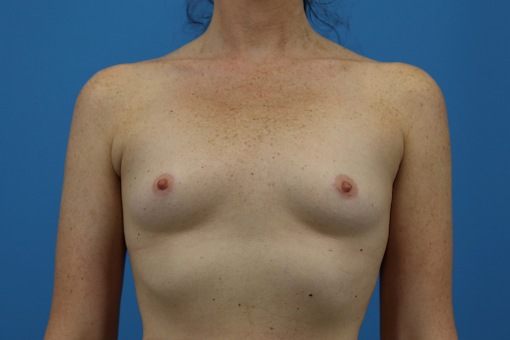 Breast Augmentation Before and After | Dr Evan W Beale