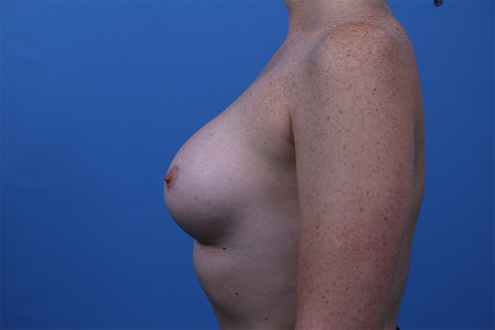 Breast Augmentation Before and After | Dr Evan W Beale
