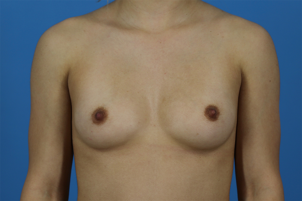Breast Augmentation Before and After | Dr Evan W Beale