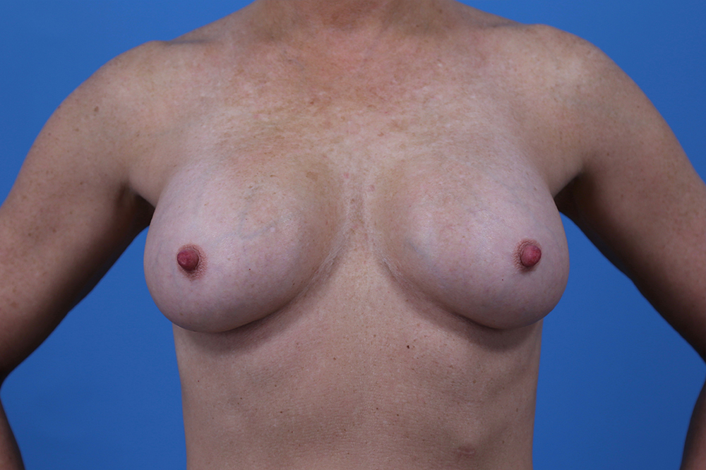 Breast Augmentation Before and After | Dr Evan W Beale