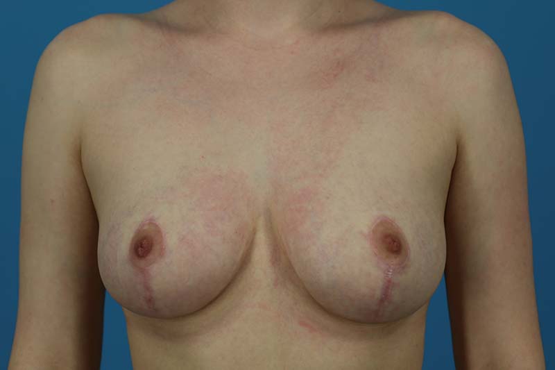 Breast Reduction Before and After | Dr Evan W Beale