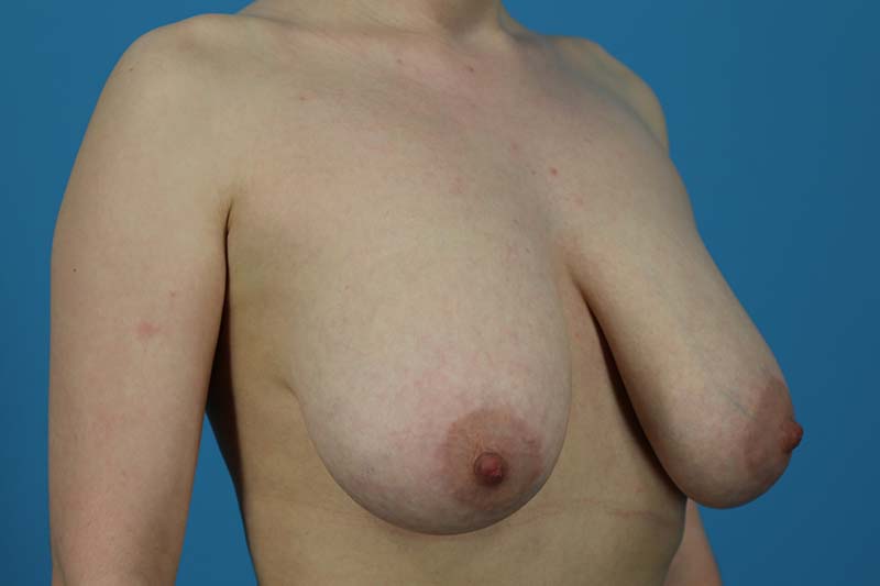 Breast Reduction Before and After | Dr Evan W Beale