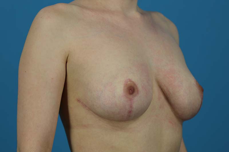 Breast Reduction Before and After | Dr Evan W Beale